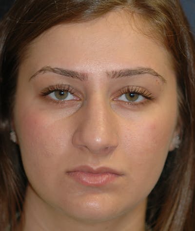 Rhinoplasty Before & After Gallery - Patient 252887 - Image 1