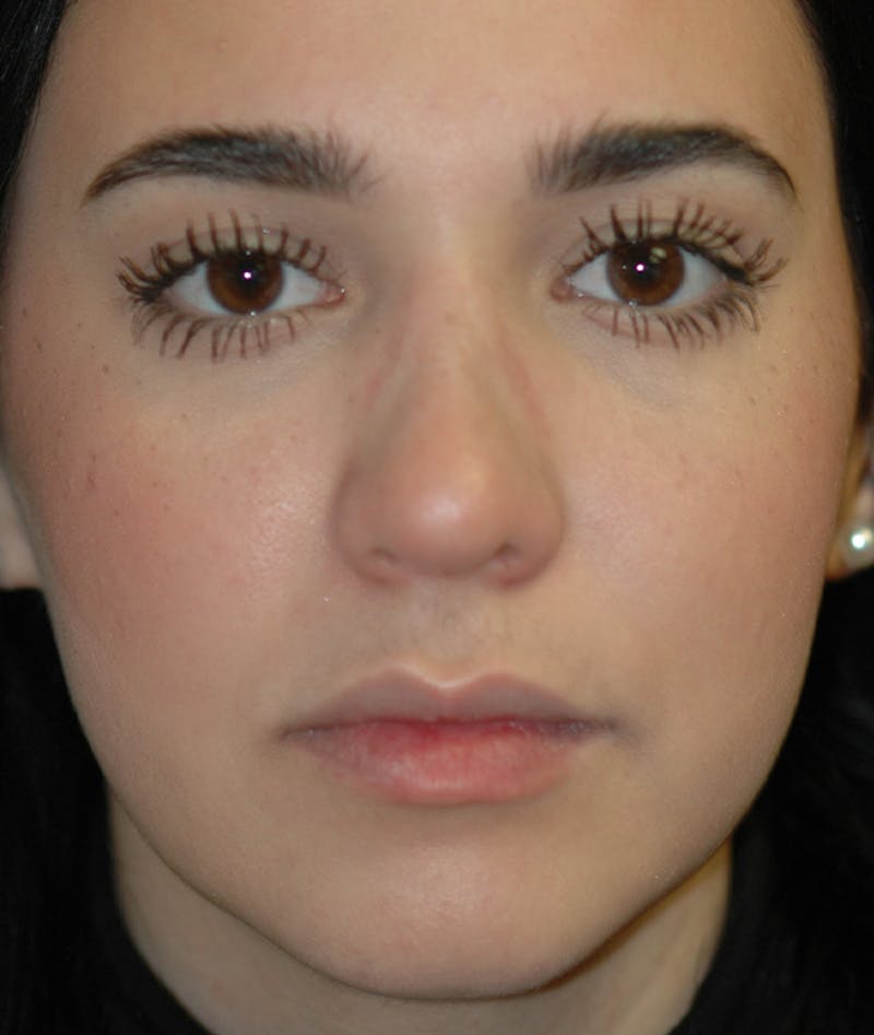 Rhinoplasty Before & After Gallery - Patient 321906 - Image 2
