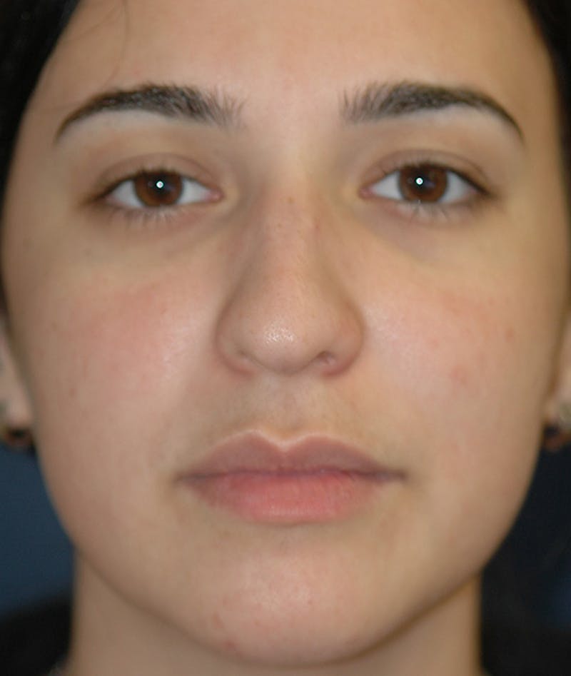 Rhinoplasty Before & After Gallery - Patient 321906 - Image 1