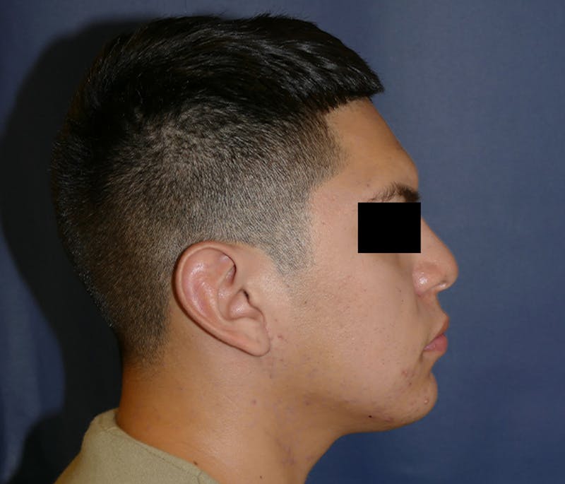 Ear Pinning (Otoplasty) Before & After Gallery - Patient 422826 - Image 8