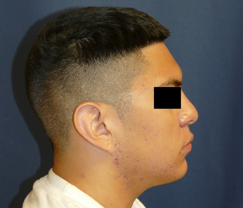 Ear Pinning (Otoplasty) Before & After Gallery - Patient 422826 - Image 7