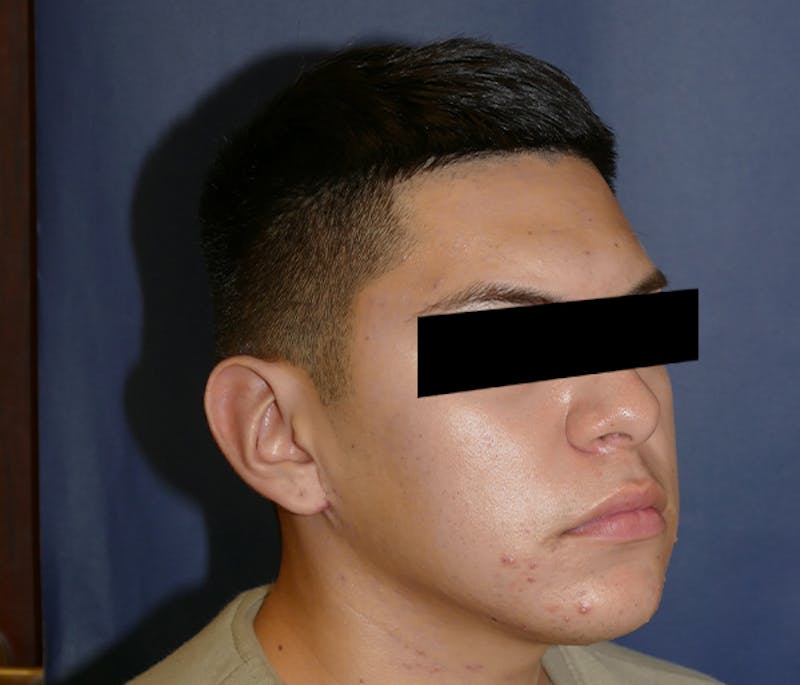 Ear Pinning (Otoplasty) Before & After Gallery - Patient 422826 - Image 6