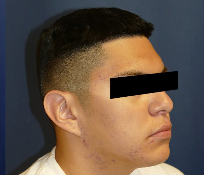 Ear Pinning (Otoplasty) Before & After Gallery - Patient 422826 - Image 5