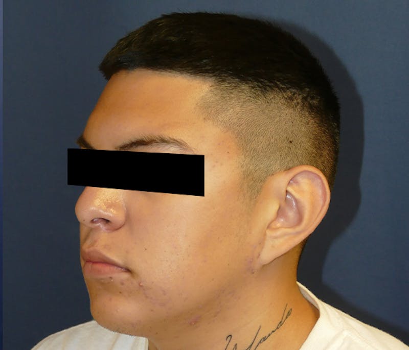 Ear Pinning (Otoplasty) Before & After Gallery - Patient 422826 - Image 3
