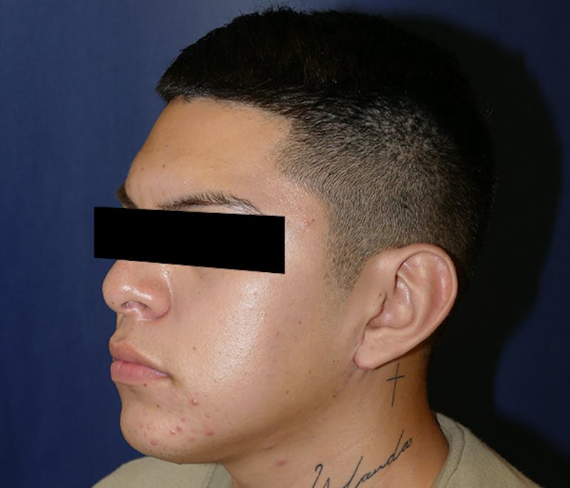 Ear Pinning (Otoplasty) Before & After Gallery - Patient 422826 - Image 4