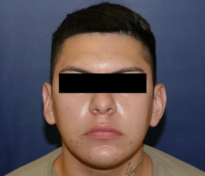Ear Pinning (Otoplasty) Before & After Gallery - Patient 422826 - Image 2