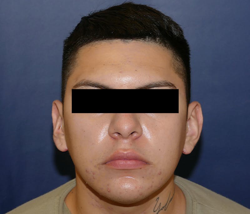 Ear Pinning (Otoplasty) Before & After Gallery - Patient 422826 - Image 2