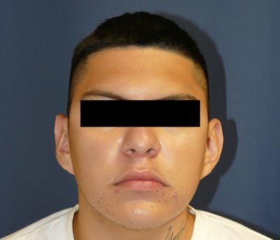 Ear Pinning (Otoplasty) Before & After Gallery - Patient 422826 - Image 1