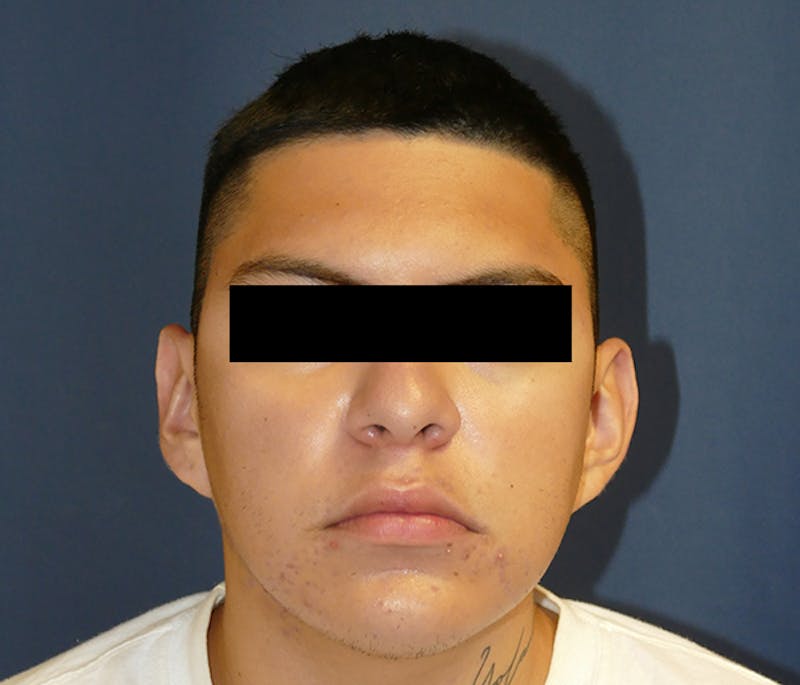 Ear Pinning (Otoplasty) Before & After Gallery - Patient 422826 - Image 1