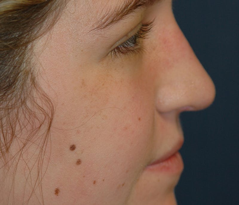 Rhinoplasty Before & After Gallery - Patient 182660 - Image 6