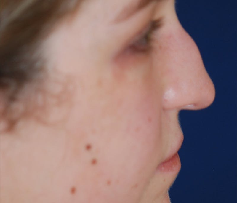 Rhinoplasty Before & After Gallery - Patient 182660 - Image 5