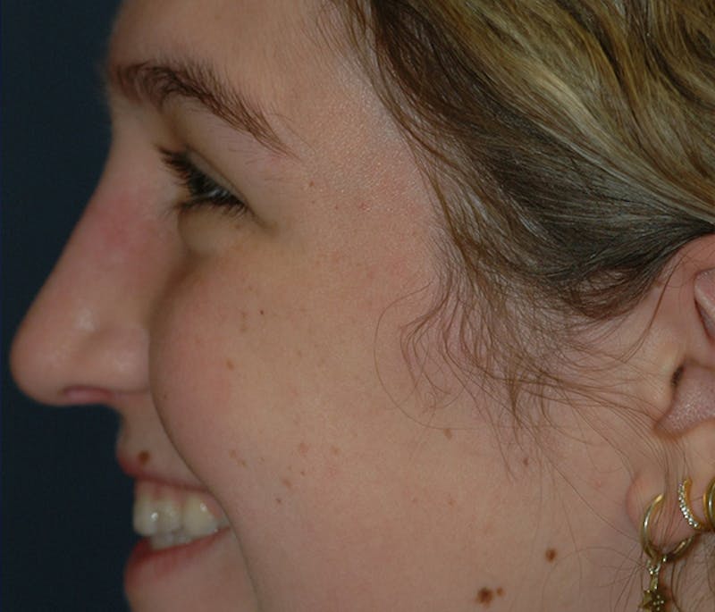 Rhinoplasty Before & After Gallery - Patient 182660 - Image 4