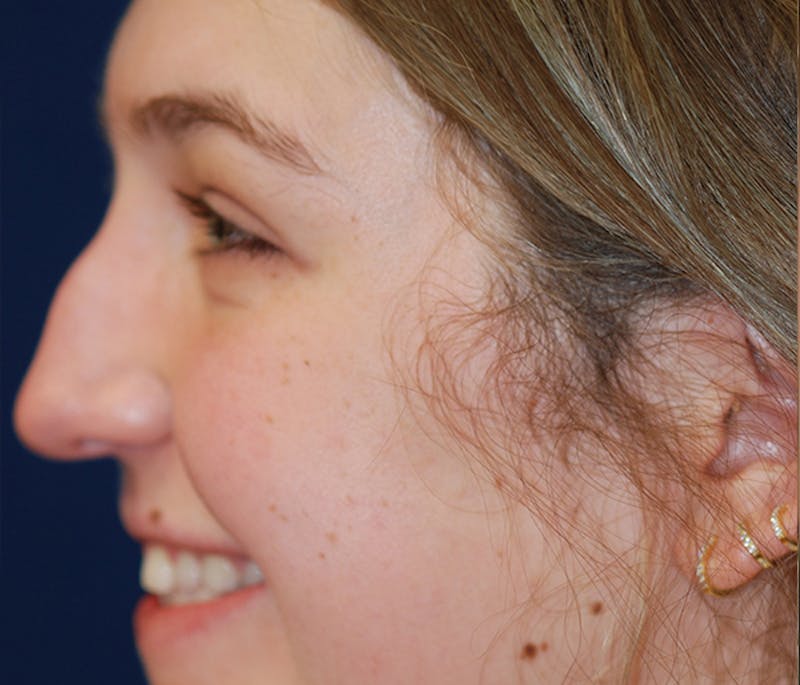 Rhinoplasty Before & After Gallery - Patient 182660 - Image 3