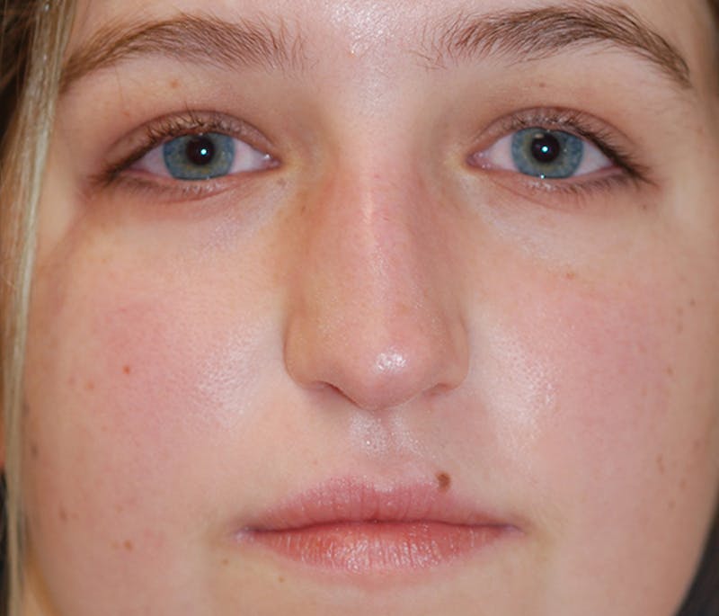 Rhinoplasty Before & After Gallery - Patient 182660 - Image 1