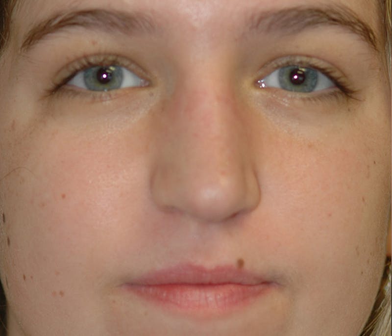 Rhinoplasty Before & After Gallery - Patient 182660 - Image 2