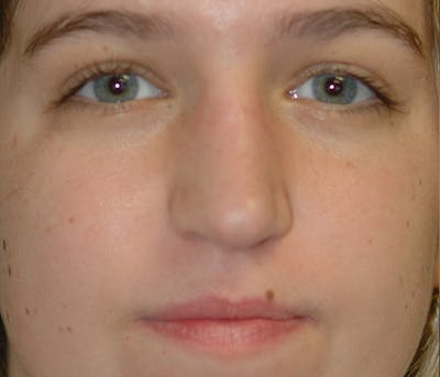 Rhinoplasty Before & After Gallery - Patient 182660 - Image 2