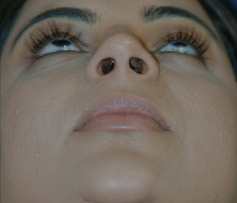 Rhinoplasty Before & After Gallery - Patient 240732 - Image 8