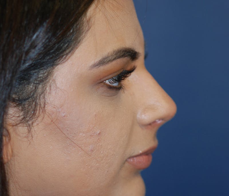 Rhinoplasty Before & After Gallery - Patient 240732 - Image 6