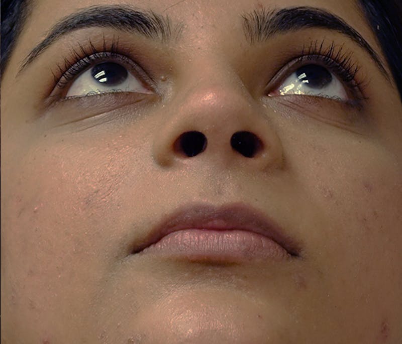 Rhinoplasty Before & After Gallery - Patient 240732 - Image 7