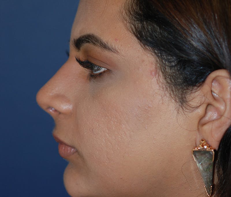 Rhinoplasty Before & After Gallery - Patient 240732 - Image 4