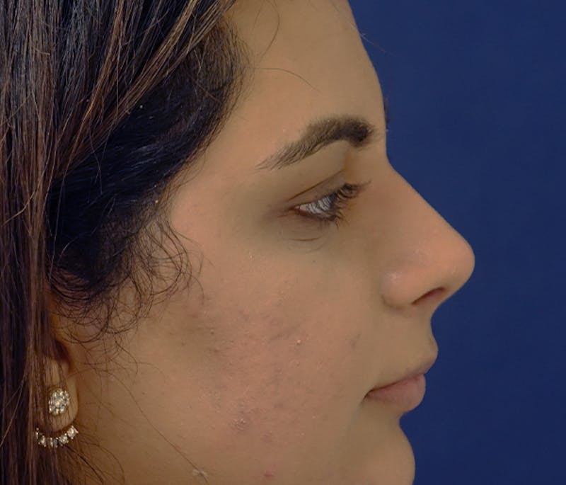 Rhinoplasty Before & After Gallery - Patient 240732 - Image 5