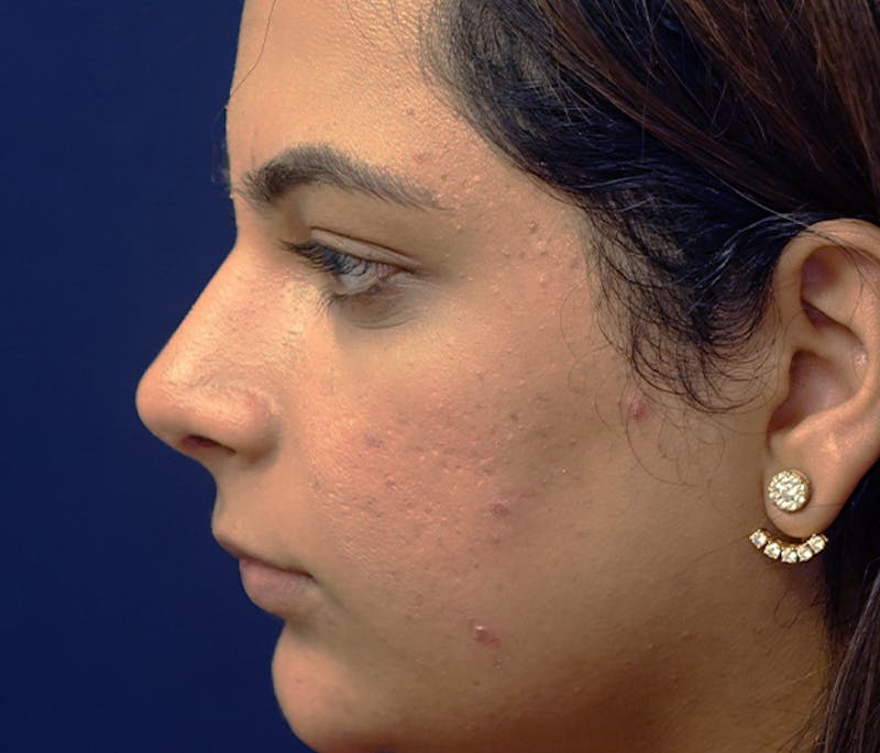 Rhinoplasty Before & After Gallery - Patient 240732 - Image 3
