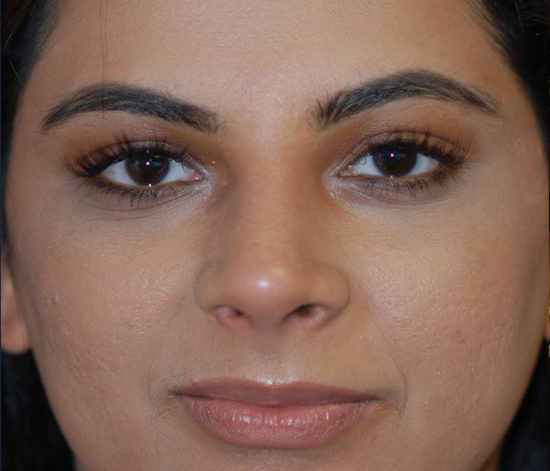 Rhinoplasty Before & After Gallery - Patient 240732 - Image 2