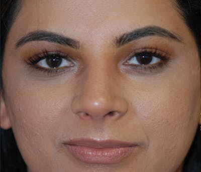 Rhinoplasty Before & After Gallery - Patient 240732 - Image 2