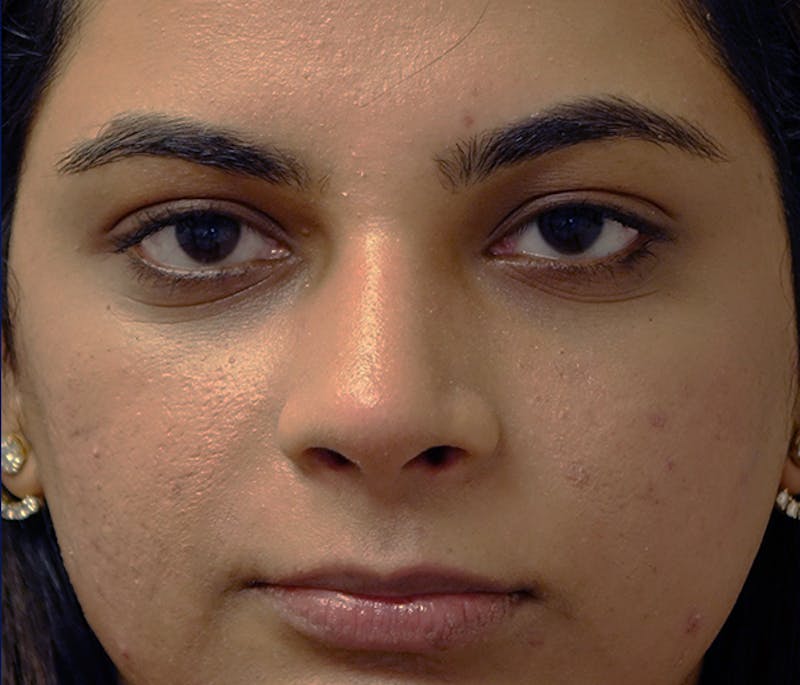 Rhinoplasty Before & After Gallery - Patient 240732 - Image 1