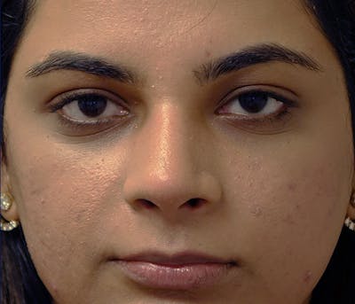 Rhinoplasty Before & After Gallery - Patient 240732 - Image 1