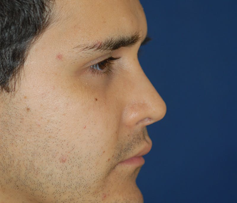Rhinoplasty Before & After Gallery - Patient 267413 - Image 4