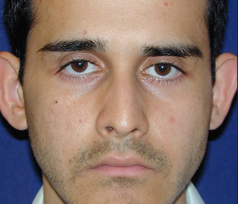 Rhinoplasty Before & After Gallery - Patient 267413 - Image 1