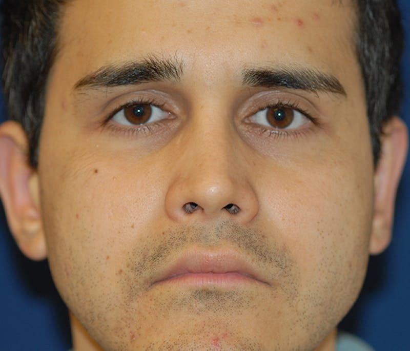 Rhinoplasty Before & After Gallery - Patient 267413 - Image 2
