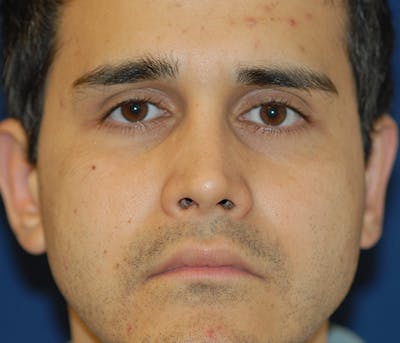 Rhinoplasty Before & After Gallery - Patient 267413 - Image 2