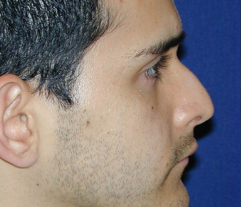 Rhinoplasty Before & After Gallery - Patient 267413 - Image 3