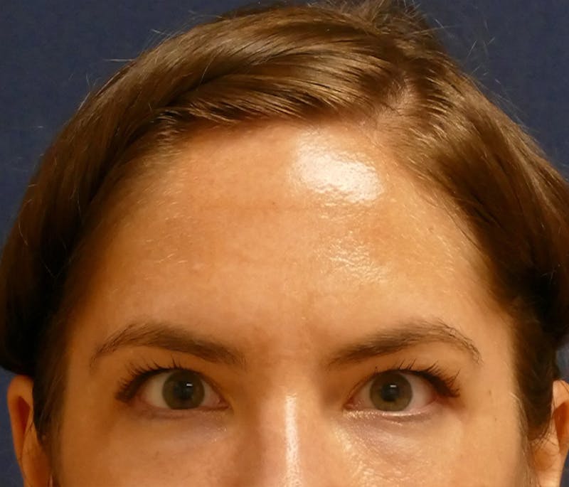 Injectables Before & After Gallery - Patient 346759 - Image 4