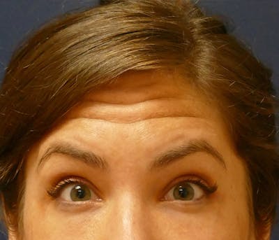 Injectables Before & After Gallery - Patient 346759 - Image 1