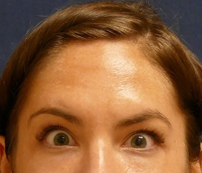 Injectables Before & After Gallery - Patient 346759 - Image 2