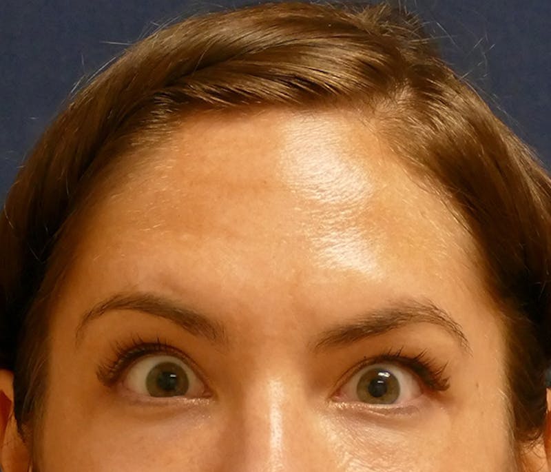 Injectables Before & After Gallery - Patient 346759 - Image 2