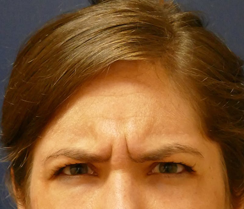 Injectables Before & After Gallery - Patient 346759 - Image 3