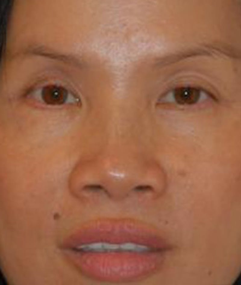 Browlift Before & After Gallery - Patient 600449 - Image 2