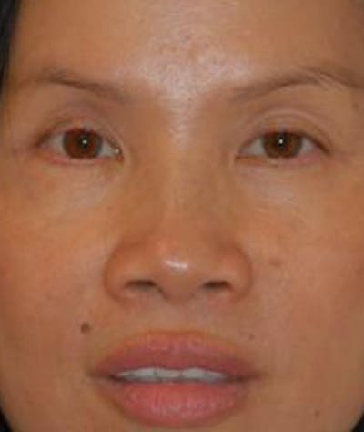 Eyelid Lift (Blepharoplasty) Before & After Gallery - Patient 302390 - Image 2