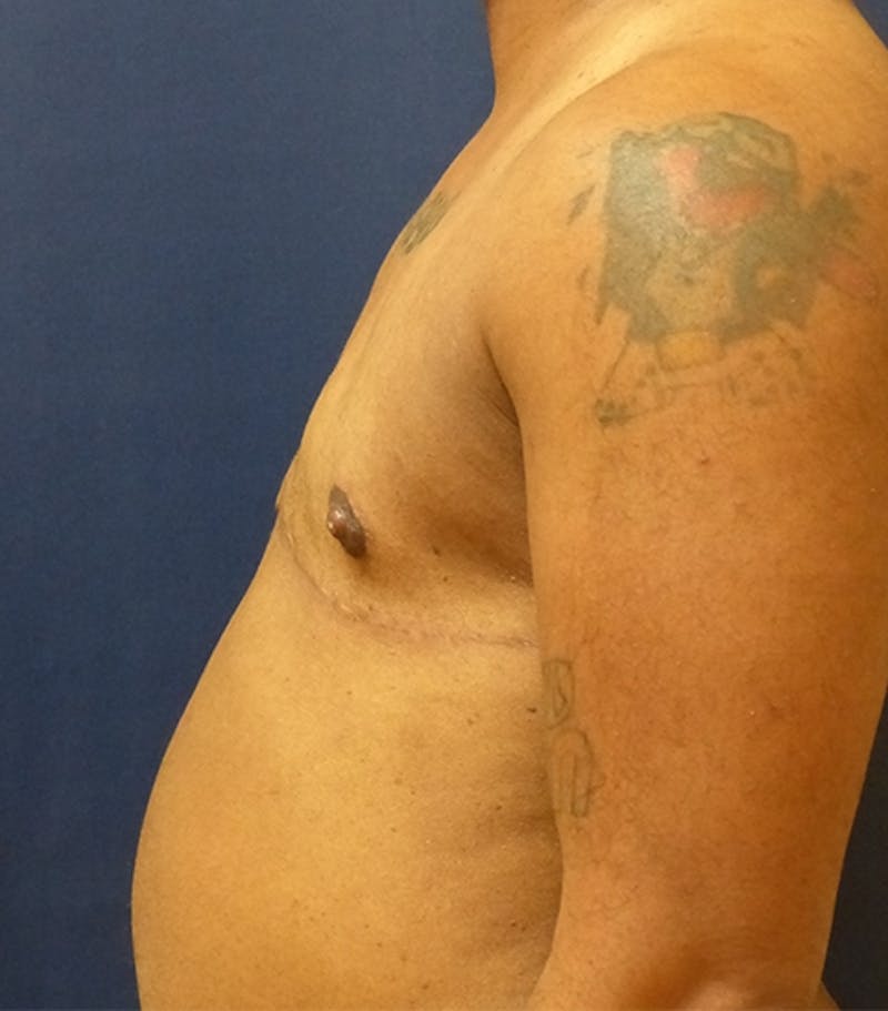 Masculinizing Surgery Before & After Gallery - Patient 802826 - Image 2
