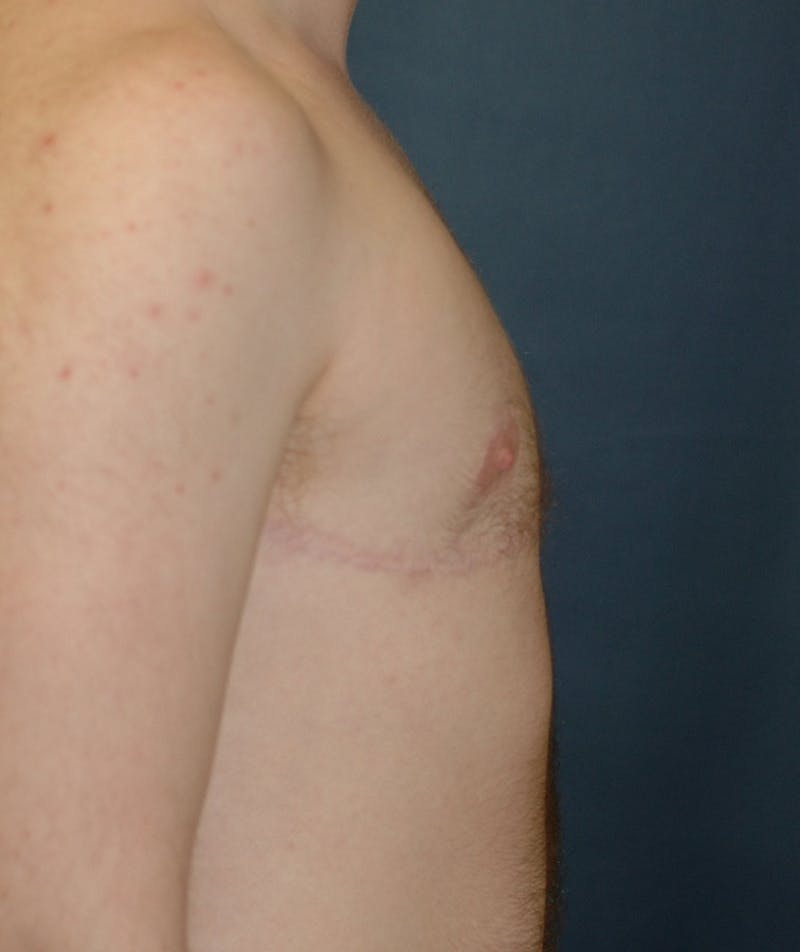 Masculinizing Surgery Before & After Gallery - Patient 141621 - Image 6