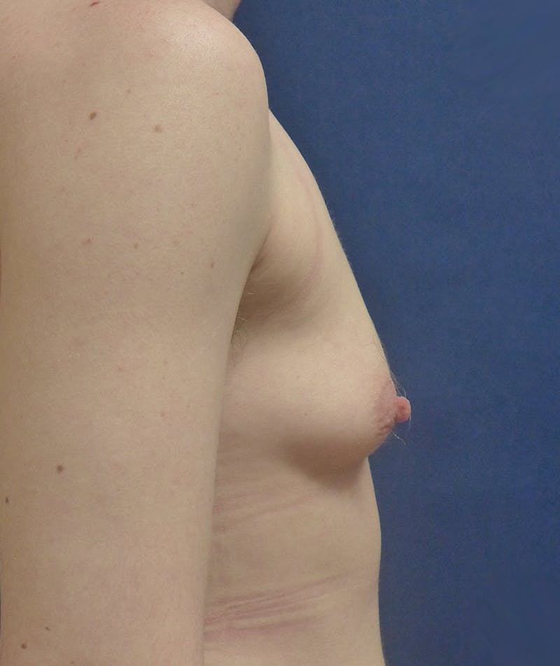 Masculinizing Surgery Before & After Gallery - Patient 141621 - Image 5