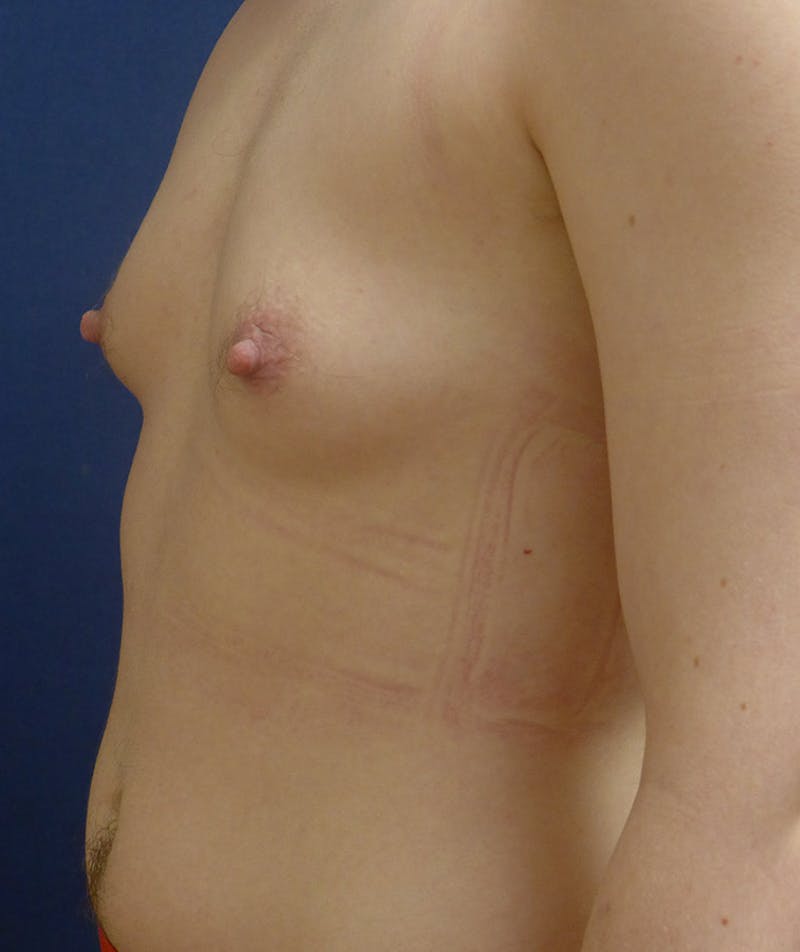 Masculinizing Surgery Before & After Gallery - Patient 141621 - Image 3