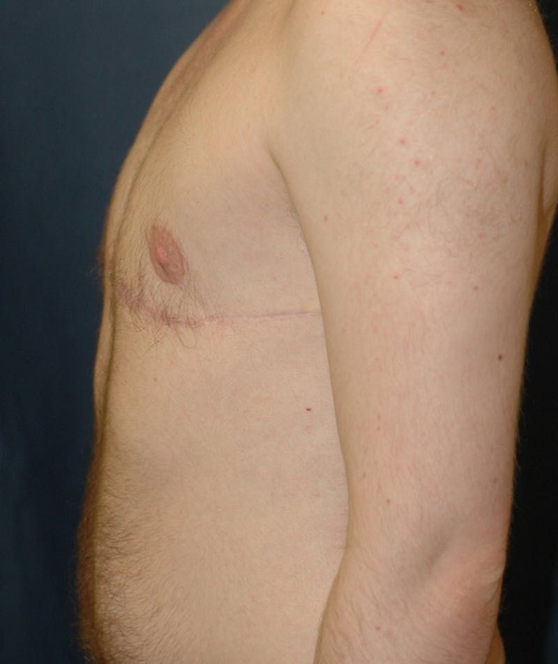 Masculinizing Surgery Before & After Gallery - Patient 141621 - Image 4
