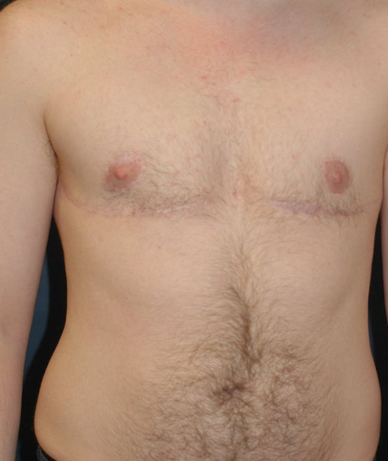 Masculinizing Surgery Before & After Gallery - Patient 141621 - Image 2