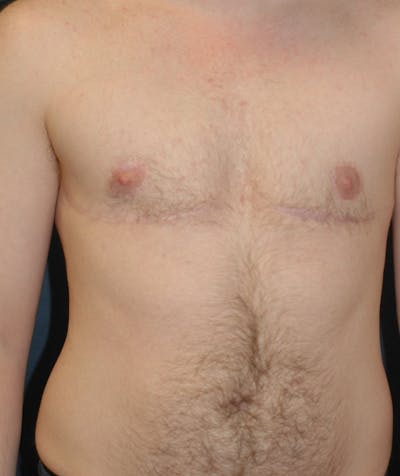 Masculinizing Surgery Before & After Gallery - Patient 141621 - Image 2