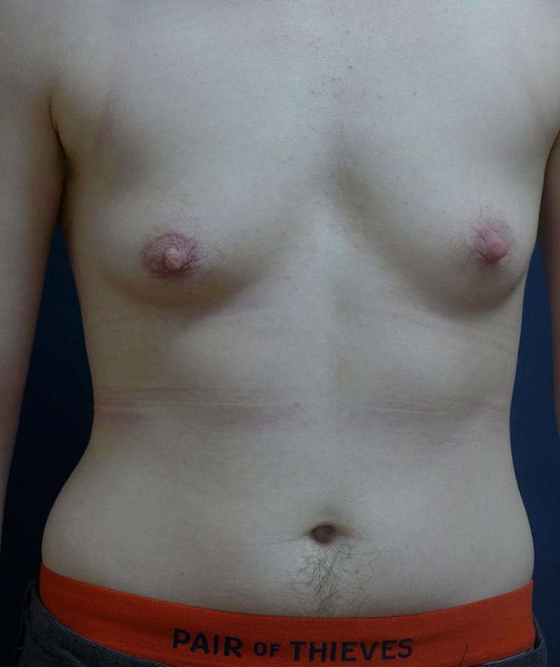Masculinizing Surgery Before & After Gallery - Patient 141621 - Image 1